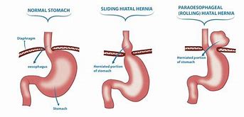 Hiatal Hernia Là Bệnh Gì