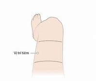 Vị Trí Tiêm Bắp Trẻ Em